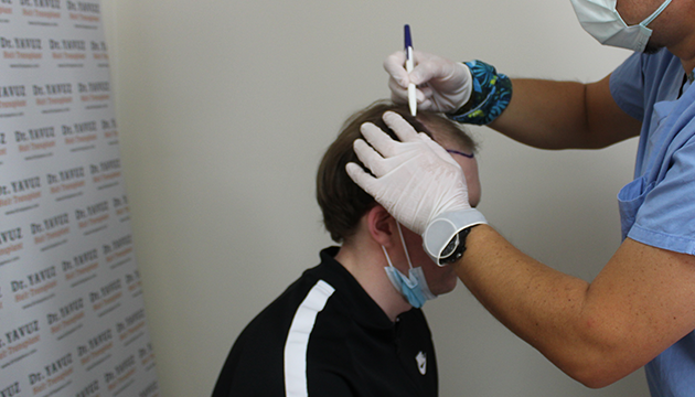 Vor der Haartransplantationsoperation