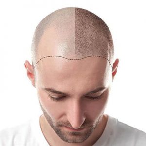 Quand est-ce que les cheveux commenceront à pousser après la greffe de cheveux?