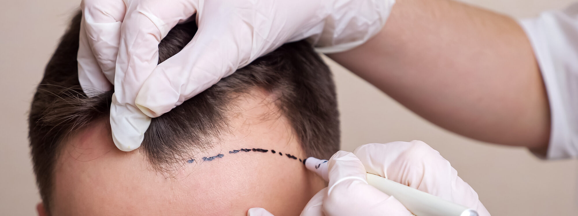 Pack Avancé de Récupération Après Greffe de Cheveux