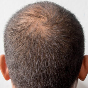 How Much Hair Loss Is Normal In The Shower?