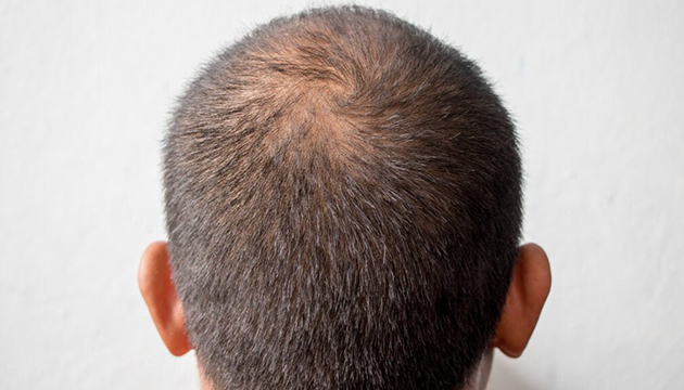 How Much Hair Loss Is Normal In The Shower?