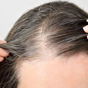 What are the Causes of Hair Loss in Women?
