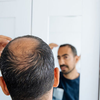 How Is Graft Count Determined in Hair Transplant?