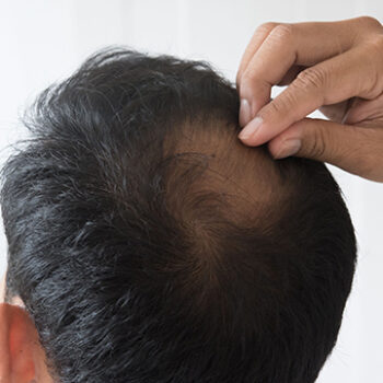 What Kind of Hair Care Should I Apply Before Hair Transplant?