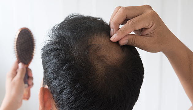 What Kind of Hair Care Should I Apply Before Hair Transplant?