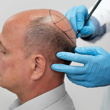 How Long Does Transplanted Hair Last