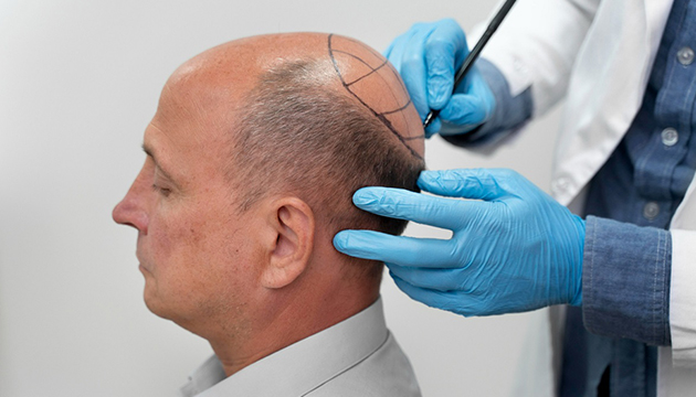 How Long Does Transplanted Hair Last