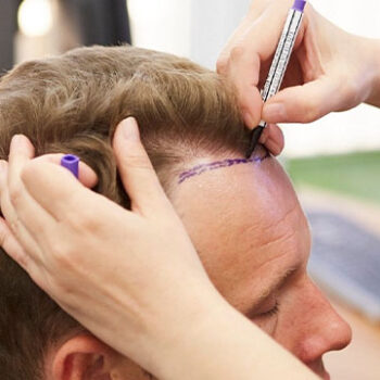 Hairline Recession and Hair Root Weakening