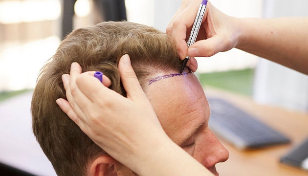 Hairline Recession and Hair Root Weakening