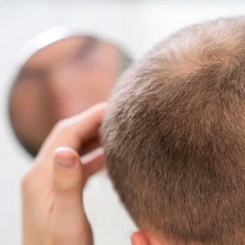 What Are the Symptoms and Causes of Hair Loss in Men?