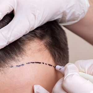 Advanced Post-Hair Transplant Recovery Package